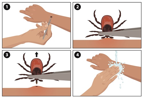 18_293708_tick_removal_rectangle_print.jpg